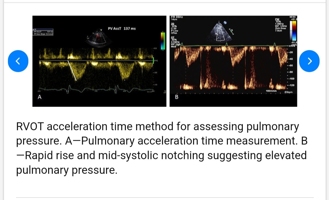 Estimation of Pulmonary Artery Pressure by ECHO
 
TR jet velocity for sPAP &amp; mPAP
PR jet velocity for mPAP &amp; dPAP
RVOT Acceleration Time for mPAP