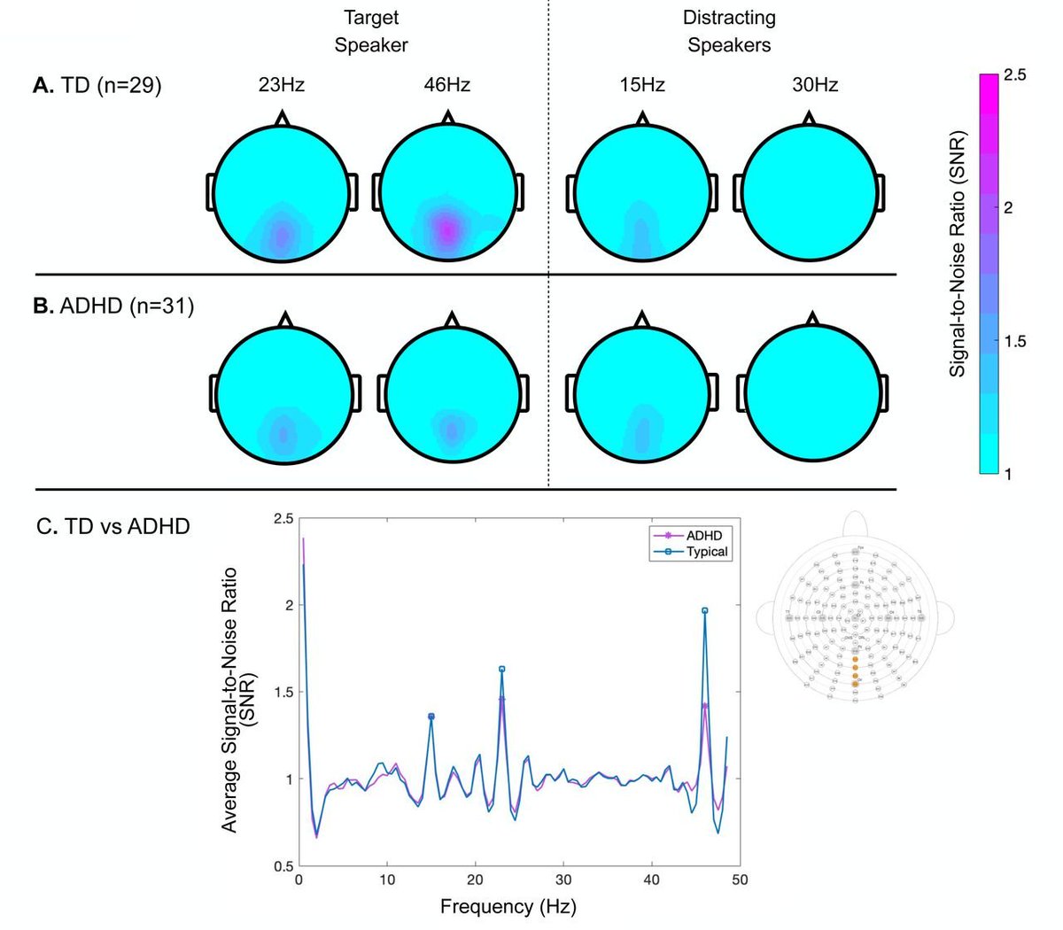 Another Preprint from our team!
“The School Cafeteria Problem”: Disrupted Visuospatial Attention During Multisensory Speech-in-Noise Perception in Children with ADHD 
<a href="/URNeuroscience/">Del Monte Institute for Neuroscience</a> <a href="/UofR/">University of Rochester</a> <a href="/CvsUor/">CVSUoR</a> <a href="/CNL_Rochester/">Cognitive Neurophysiology Laboratory - Rochester</a> 
#AudioVisual #ADHD #URochesterResearch
biorxiv.org/content/10.110…