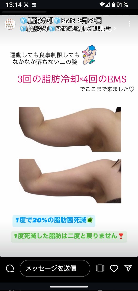 脂肪冷却③ ルビーパレス｜ルビー館 RUBY-PALACE｜（サウナ・アカスリ24時間営業の