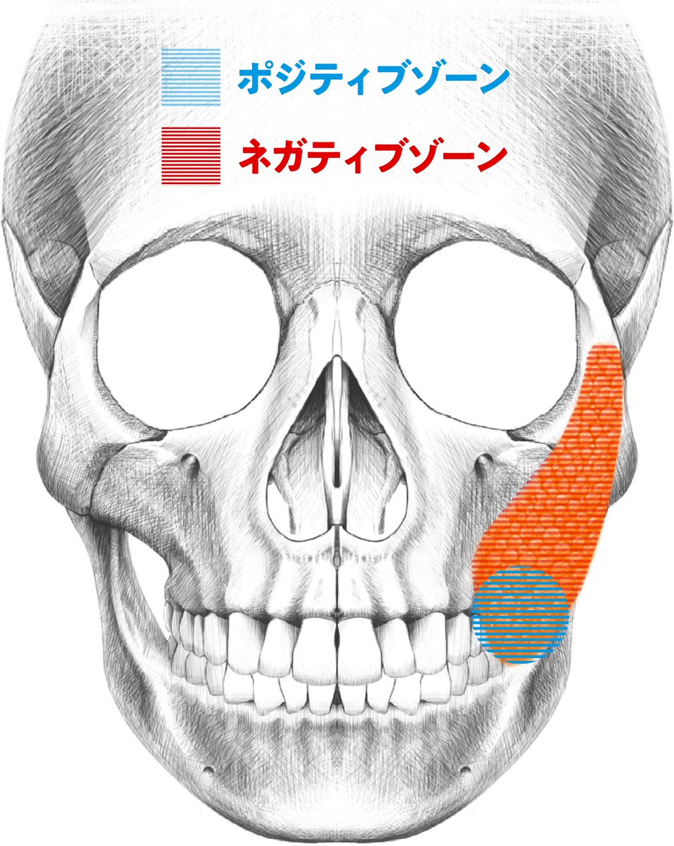 dr_asano_tomo's tweet photo. マジで広まって欲しいこと(顔の脂肪吸引)

顔の脂肪は財産であり負債💸

・ポジティブゾーンは負債なので放っておくと下垂するから適度に取ってもいい

・ネガティブゾーンは財産なので取るな

これに尽きます。 https://t.co/4B6oZ15ccI