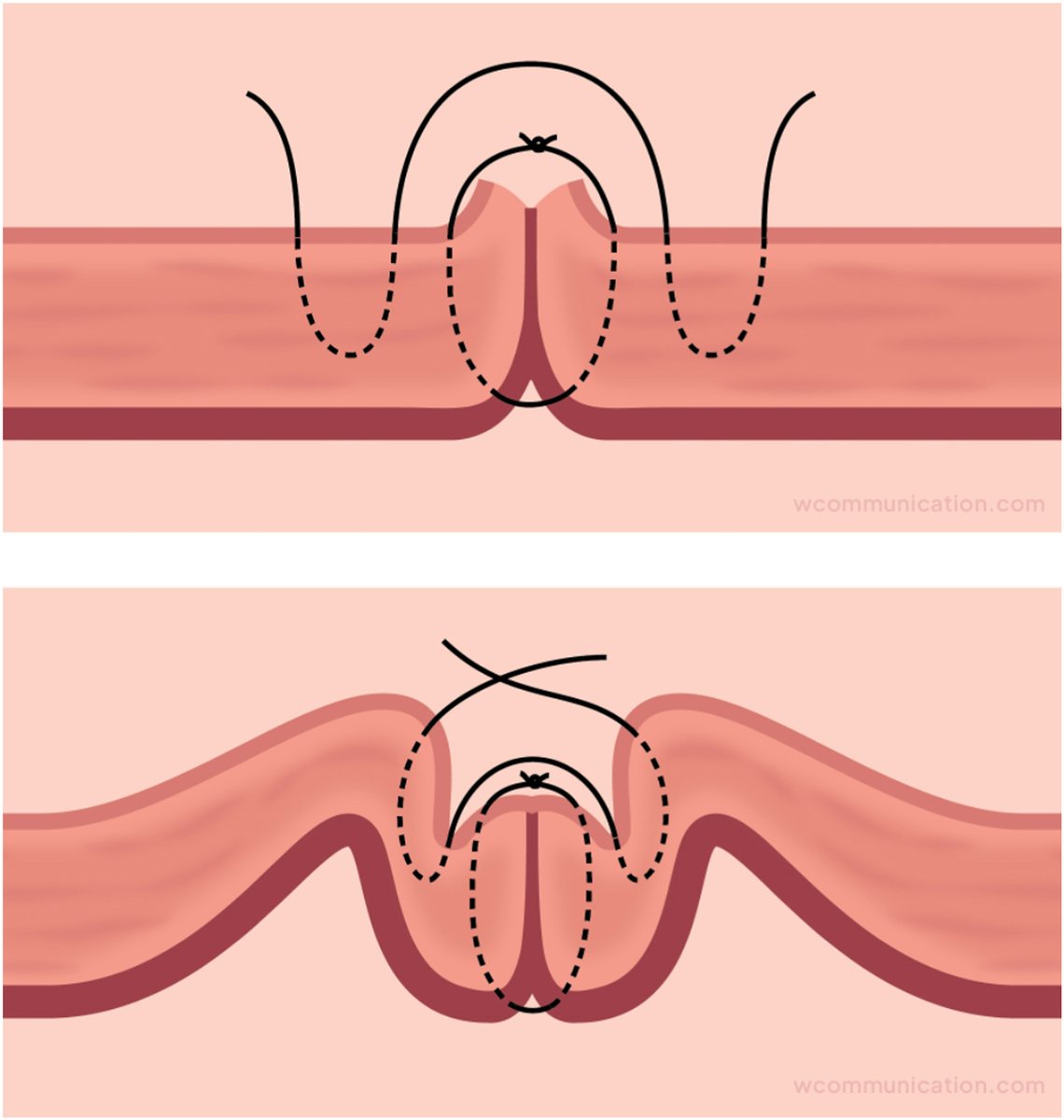 AJOG_thegray's tweet image. AJOG Expert Review: Uterine closure after cesarean delivery: surgical principles, biological rationale, and clinical implications - The effect of adding a second layer over a first layer including all uterine layers ow.ly/L1Ul50Xs4me