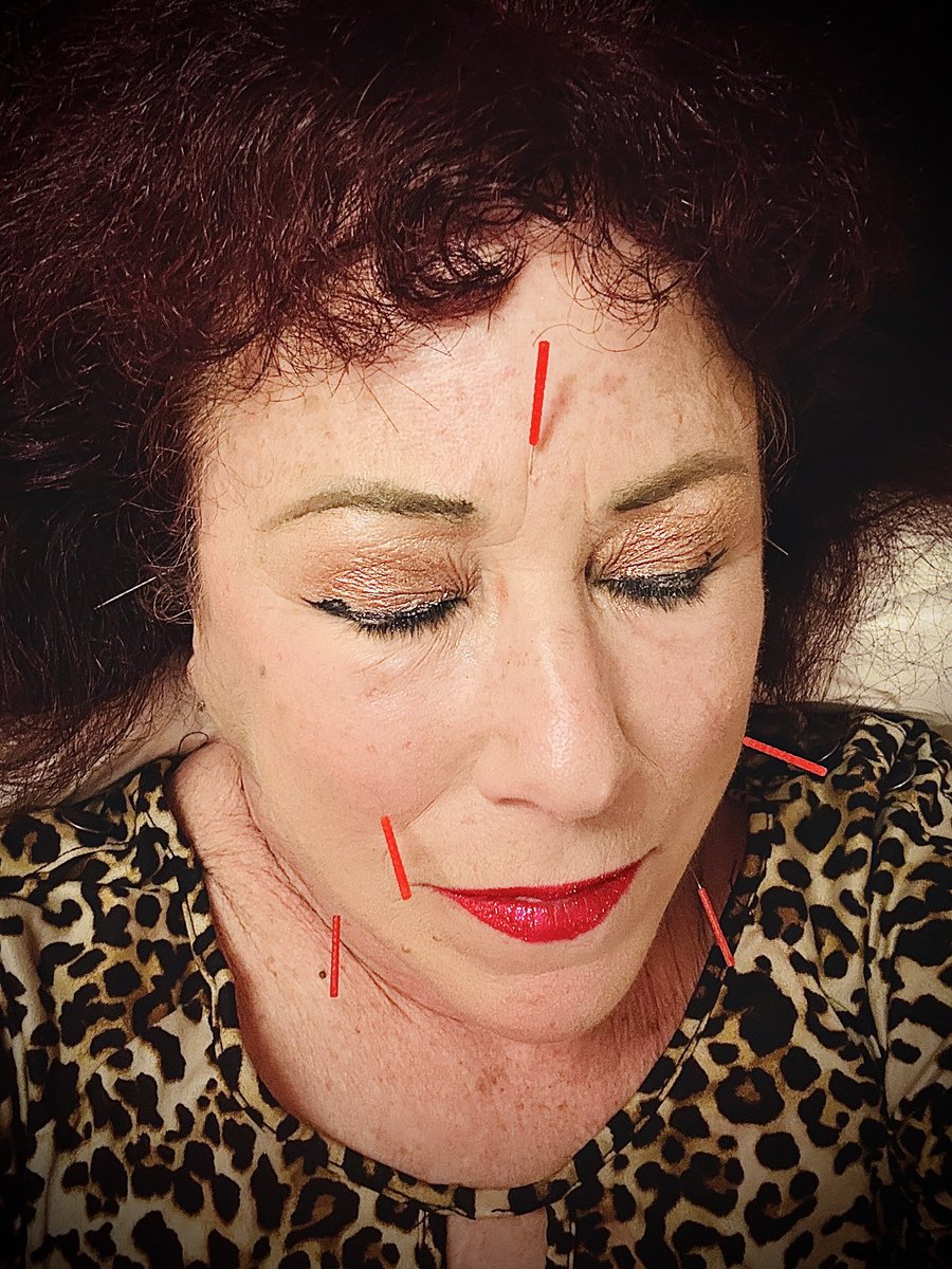 Acupuncture selfie. Heal everyone and everything is my motto. Our Love Infusion Clinic at Cushionworks Gallery is open today in San Fran. (Van Ness &amp; 18 st) We will be there giving tours of the Bazoombas in Love also. Come n git tit!