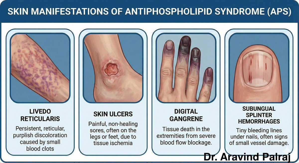 🩸 APS doesn’t always start with a clot in the brain or lungs.
Often, the first warning signs are on the skin — and they’re easy to miss.

🔍 Livedo.
🔍 Non-healing ulcers.
🔍 Painful purple digits.
🔍 Splinter hemorrhages.

If you see these together, think Antiphospholipid