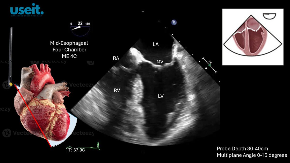 pocus_today's tweet image. The ME4C view is obtained at a probe depth of between 30-40cm. The multiplane angle is set at between 0-15 degrees. All 4 cardiac chambers can be seen. The beam should pass throught the apex of the heart. 
#useit mobile app
#TEE
#POCUS