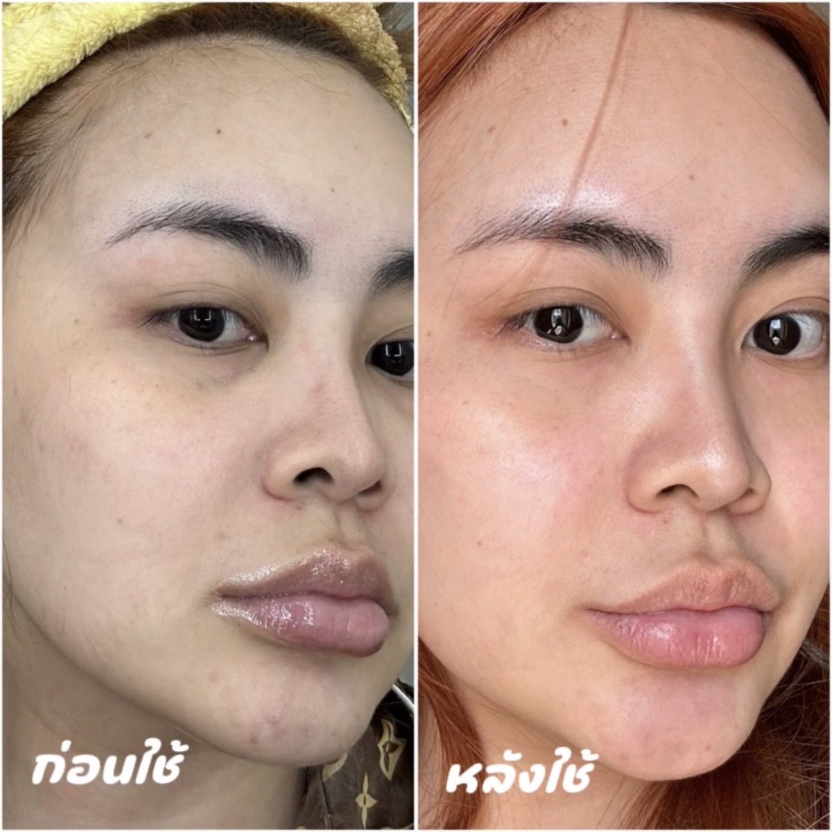 แป้งน้ำแต้มสิวตัวใหม่ skintific 💚 เค้ามาเป็นเซ็ตพร้อมก้านสำลีแต้มสิว ทาก่อนนอน 4-5 วัน สิวยุบ รอยสิวจาง เป็นแป้งน้ำแต้มสิวแห้งไว ไม่ต้องกลัวเลอะหมอน สามารถให้เป็นของขวัญปีใหม่นี้ได้ด้วย 🎄🎁✨ #แป้งน้ำแต้มสิวskintific #skintific #ป้ายยาสกินแคร์
