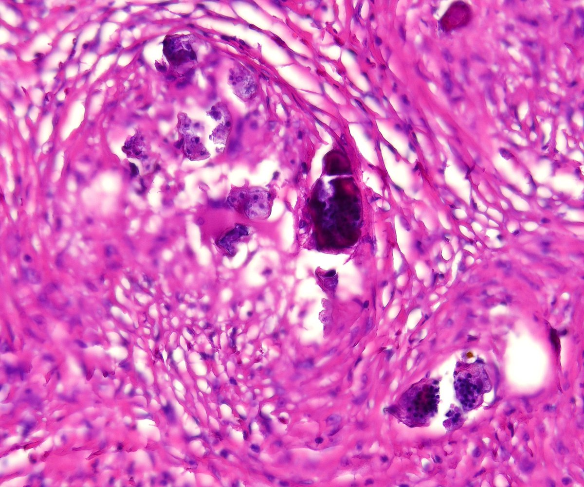 Testicular tumor in a young boy.
What's your diagnosis?

#GUPath #PathTwitter #Crittersontwitter