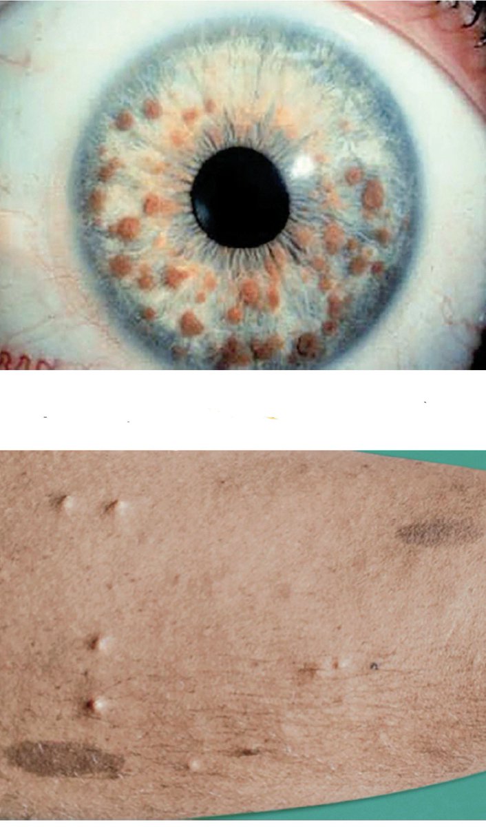 What’s spot diagnosis? other features linked to the condition?