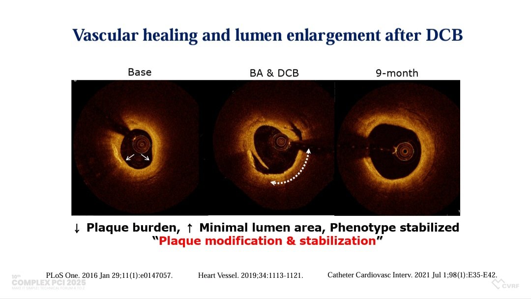 Zill_cardio's tweet image. Current Status and Future Impact of DCB in #ComplexPCI

💫Benefits of DCB in complex PCI👇

💥Simpler strategy for complex lesions 

💥Simplified sizing &amp;amp; length selection  

💥Shorter DAPT

💥 NO stent-related comp. 

💥Enables natural vessel healing

💥Facilitates future Revasc