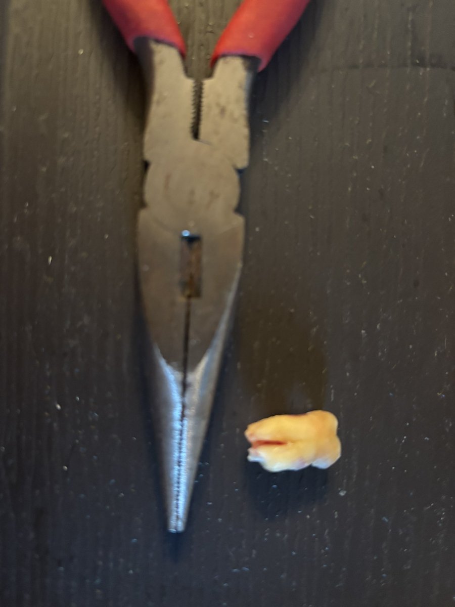 i_to_u____'s tweet image. 今朝
すごくグラグラしてるから
自分で親知らず
抜いちゃったんだけど
10代の頃に
いろいろあって
グラグラしちゃったんだけど
不安定な物が
一つ無くなっただけで
なんだか
いろいろな事柄が
安定した気がする
久しぶりに
両側で咀嚼出来る喜びを
噛み締めたいと思います✨