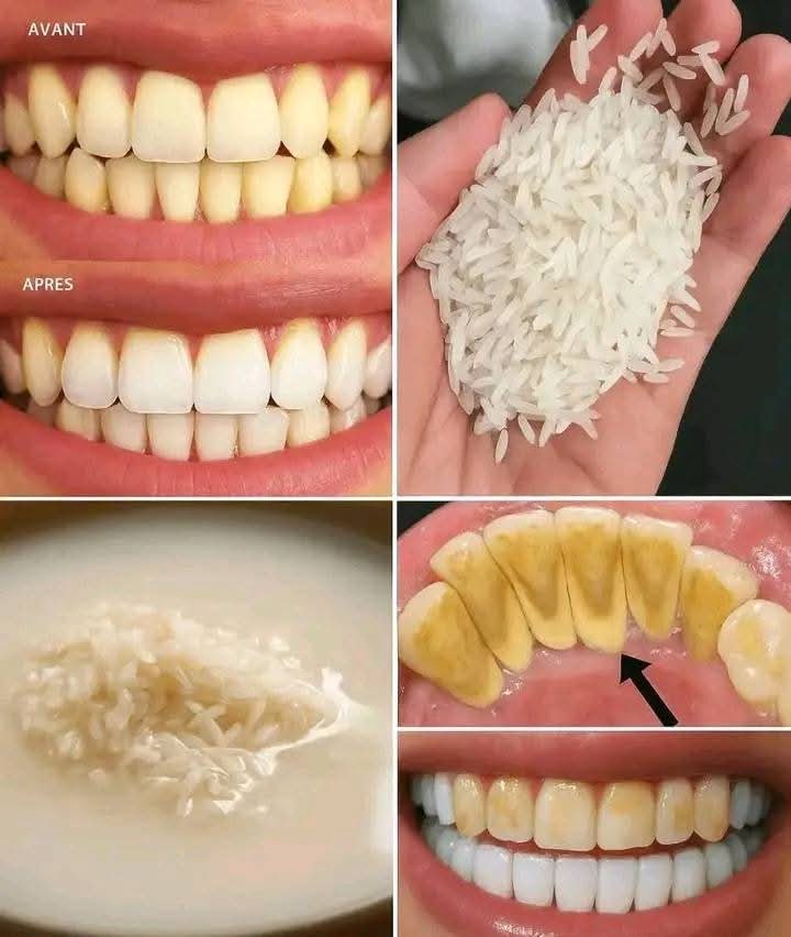 Rice Water for Teeth? Yep—your grandma’s beauty secret just pulled up with a dental glow-up. Two minutes, two ingredients, and zero drama. Let’s break it down. 👇