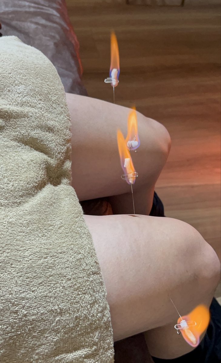 火焔鍼で暖をとる昼休み