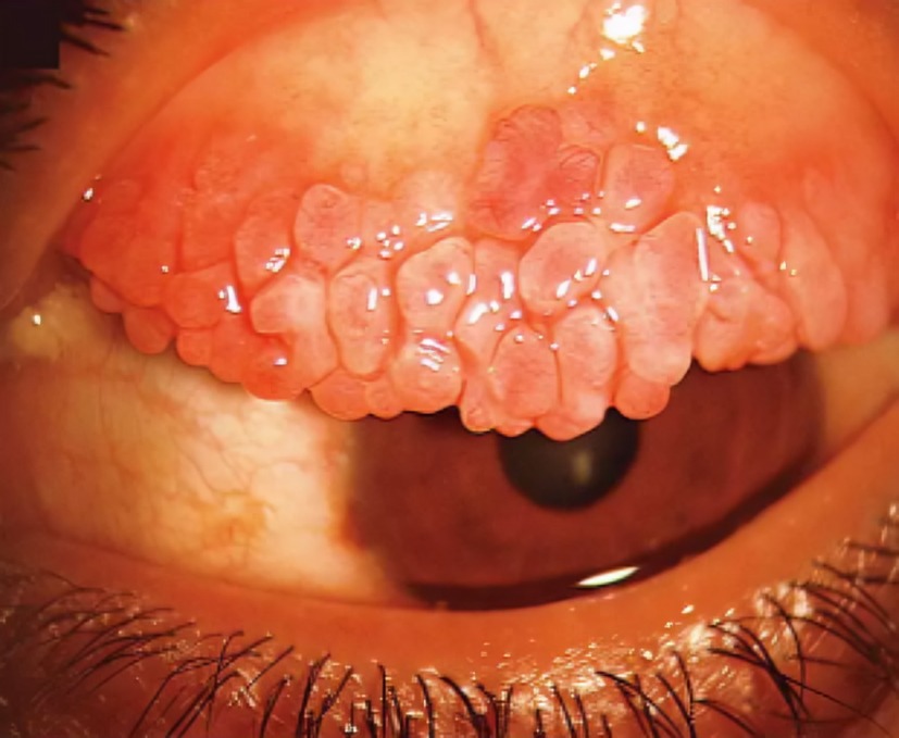 Drbhatiaacademy's tweet image. What is the diagnosis?

A. Blepharitis
B. Entropion
C. Eyelid wart
D. Keratoconjunctivitis sicca
E. Vernal keratoconjunctivitis

Comment your answer and Let&apos;s see who nails it first!

#DBA #MRCP #drbhatiaacademy #MedicalEducation #usmlestudy #medquiz #doctor #medicalstudent