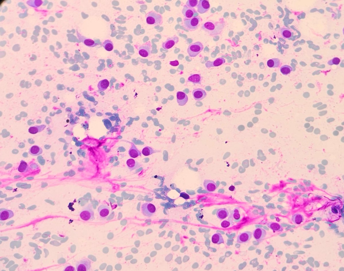 60/M well defined 2cm swelling above rt upper lip #cytopath #pathtwitter <a href="/pepeheffernan/">Pepe Jiménez Heffernan</a> <a href="/vi_monappa/">Vidya Monappa</a> <a href="/DrGeeONE/">Olaleke Folaranmi</a> <a href="/kriyer68/">Kalyani Bambal</a> <a href="/kr_abhisek/">Abhisek Kumar, DNB</a>
