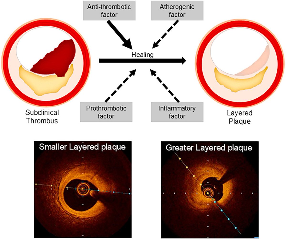Atherosclerosis Plus tweet media