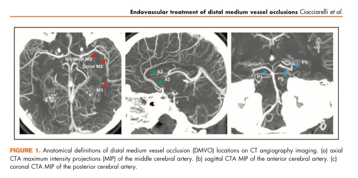 johanna_ospel's tweet image. 🚨#EVT for #MeVO #DMVO- what’s known and what’s next🤔🤯 check out this @CO_Neurology review by Antonio Ciacciarelli &amp;amp; @UPensato !!
📝 journals.lww.com/co-neurology/a…