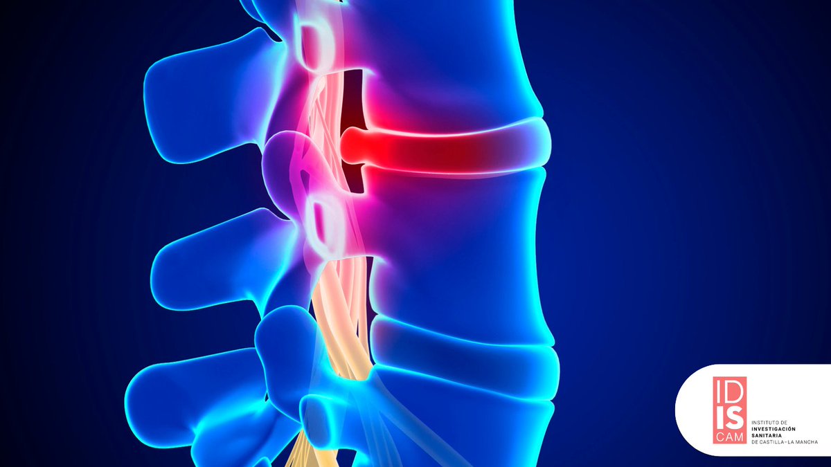 idiscam's tweet image. 🔍 La investigación de Elisa López estudia biomateriales innovadores (como andamios y geles bioactivos) y cómo responde el sistema inmunitario en lesión medular crónica, con el objetivo de favorecer la reparación del sistema nervioso del #paciente

👉 idiscam.es/investigacion/…