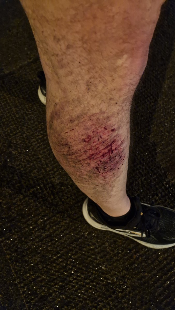 Bleeding for the cause. Only halfway through my Double Marathon Challenge, and I've done myself some damage this morning. <a href="/dublinmarathon/">Irish Life Dublin Marathon</a> ✅️ <a href="/LondonMarathon/">TCS London Marathon</a> t - 5 Months...

Any support gratefully received. Now, where's that Savlon? 

idonate.ie/CarlHoodMarath…