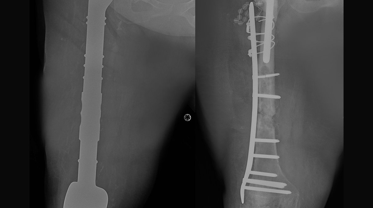 ظلت طريحة الفراش لأكثر من "14" سنة
مستشفى الدكتور سليمان الحبيب بالخبر يستبدل مفصلي الركبة والورك وعظمة الفخذ ويزيل ورما وزنه "20" كجم ويعيد "الحركة" لـ"ستينية"

لمزيد من التفاصيل، زوروا موقعنا: 
hmg.com/ar/Pages/NewsD…