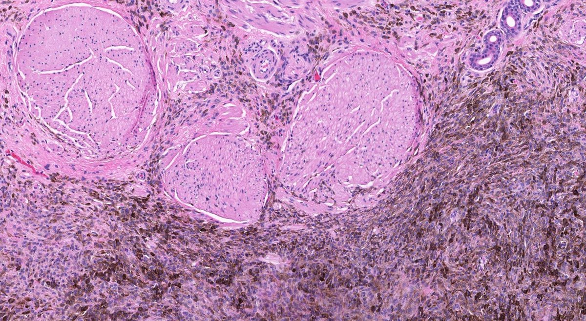 54 M. Gray nodule on back. Diagnosis?
Answer ✅ youtu.be/NcTPZB3YnXQ?si… 
Digital slide: kikoxp.com/posts/24430
#pathology #pathologists #pathTwitter #dermpath #dermatology #dermatologia #dermtwitter #BSTpath