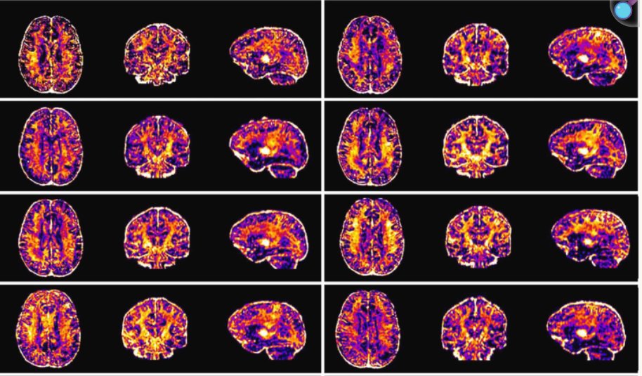 Hull_EllisCC's tweet image. 🧠🏃‍♂️ New study finds that running a marathon can briefly change certain brain signals linked to myelin—
Severe endurance exercise may tap into myelin lipids as an energy reserve.
#Neuroscience #ExerciseScience

Read more here! pubmed.ncbi.nlm.nih.gov/40128612/