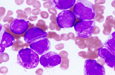 imdps_'s tweet photo. Acute Promyelocytic Leukemia (APL):
APL = AML subtype with t(15;17) → PML-RARA fusion.  
Hallmark: hypergranular (or hypogranular) promyelocytes + bleeding risk (DIC).  
Treat with ATRA + Arsenic Trioxide → >90% cured!  

#APL #Leukemia https://t.co/A7cDvvByI7