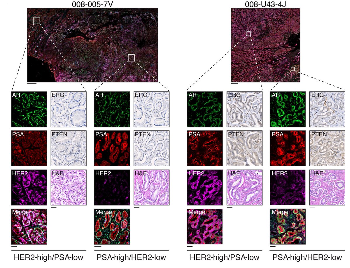 jclinicalinvest's tweet image. In #ProstateCancer, the initial biopsy carries more information than we thought.

Adam G. Sowalsky &amp;amp; team @theNCI discover aggressive untreated prostate cancers harbor a subpopulation of tumor cells with elevated levels of HER2 that may be sensitive to HER2 inhibitors:…
