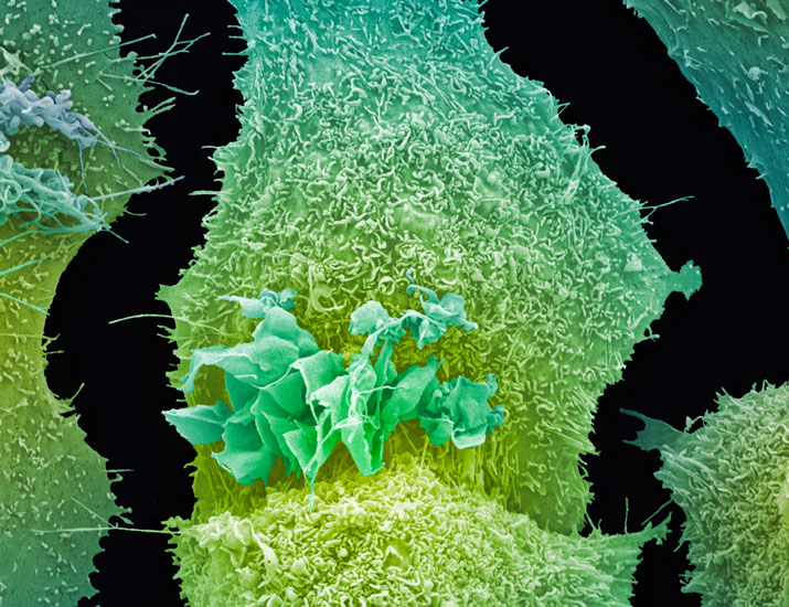 scisignal's tweet image. New research involving cells, spheroids, and mice suggests that drugs that inhibit a protein named SOS1 could enhance the staying power and efficacy of the frontline therapy #osimertinib for some patients with non-small cell #LungCancer. @USUhealthsci scim.ag/49DrN3S