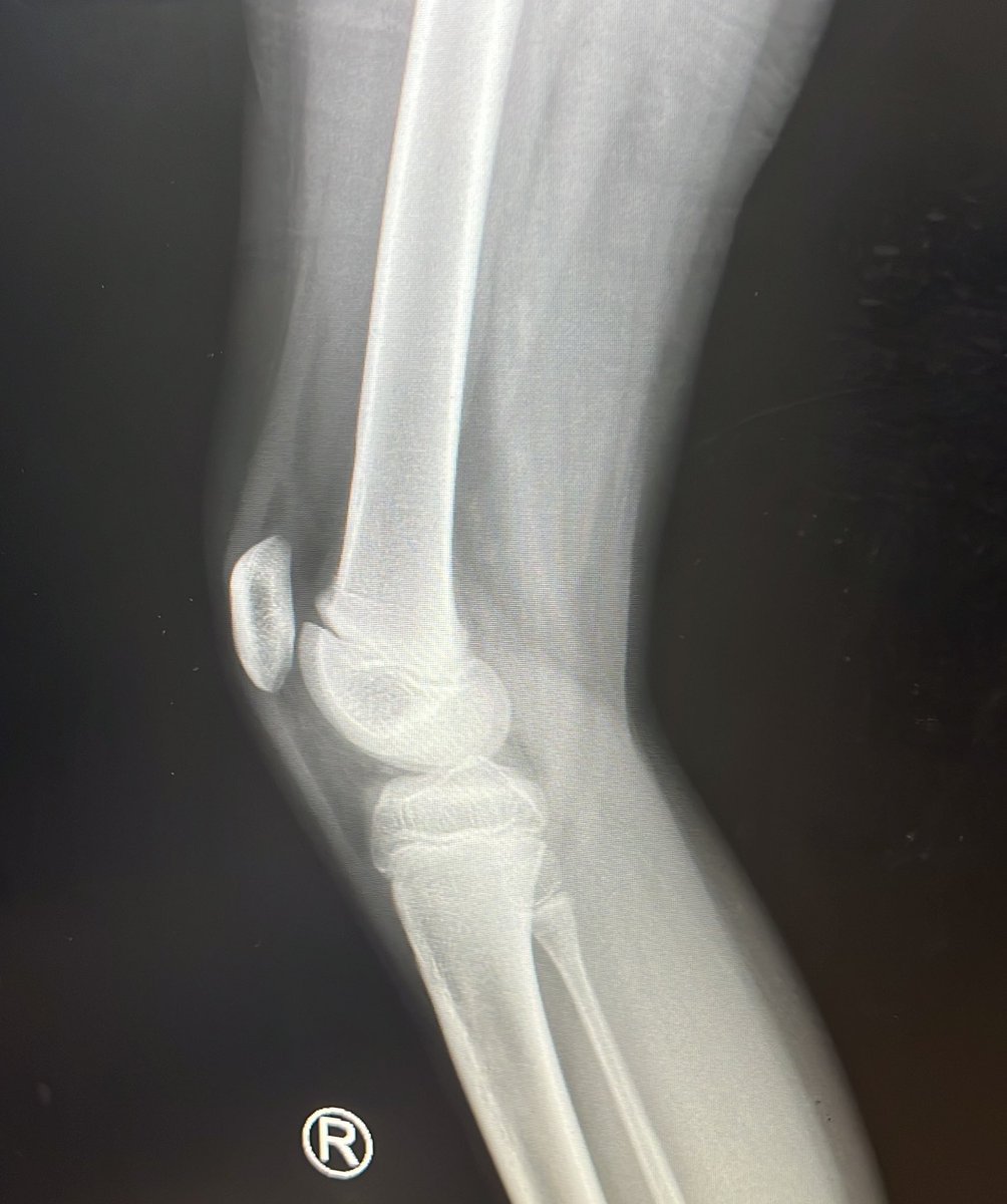 centerofhip's tweet image. 10 year old healthy girl with left sided knee pain, 2 weeks. She localises pain to lateral aspect thigh and knee
Diagnosis? 
#orthotwitter
#orthox