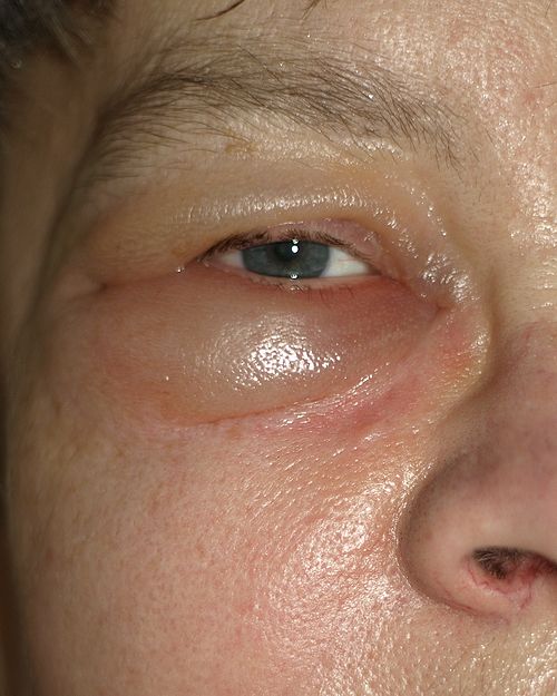 TrackYourHeart's tweet photo. Periorbital edema is a classical feature of:
A. Cirrhosis of liver
B. Nephrotic syndrome
C. Right heart failure
D. Lymphedema https://t.co/YRFW6CAMMp