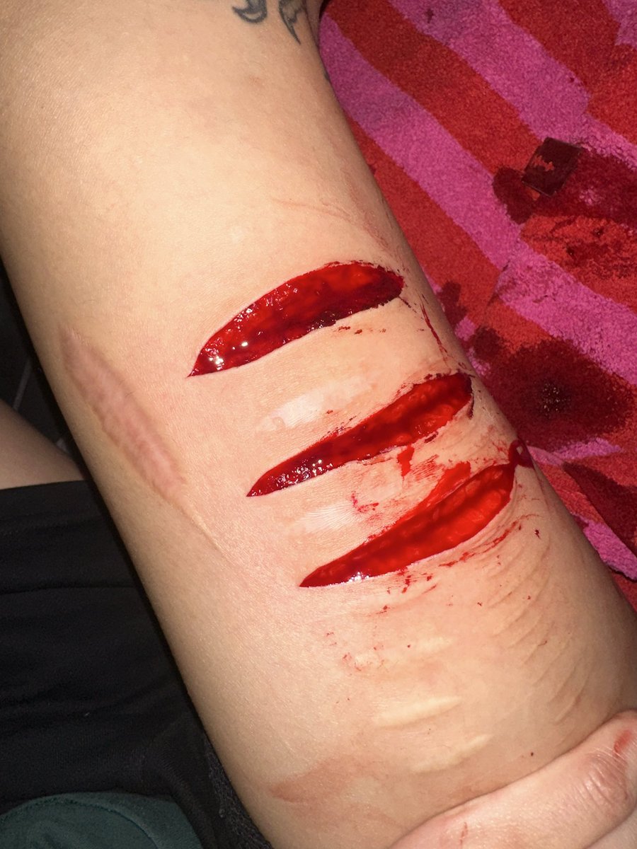 these three tonight. did not feel enough but still went to the ER since i couldn’t really close them myself