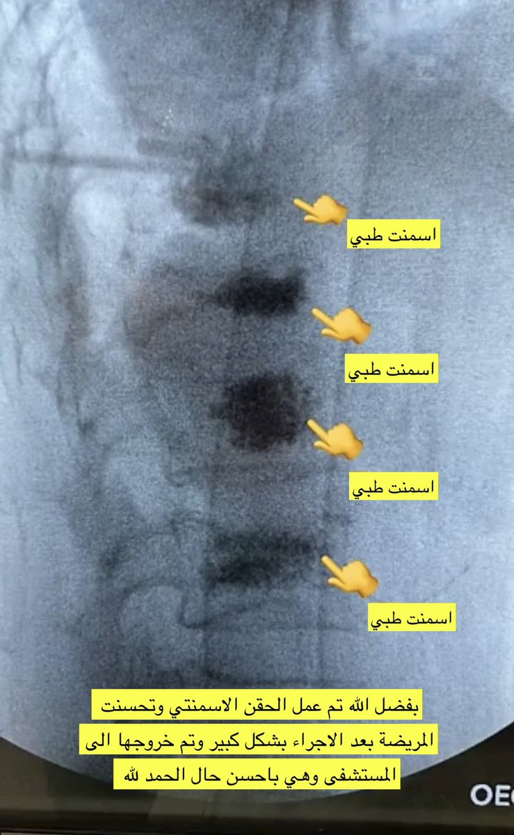 drwaleedq's tweet photo. ✨ حالة جديدة لمريضة بعمر 70 سنة
كانت تعاني من آلام شديدة بسبب كسور هشّة في فقرات الظهر…
وبفضل الله ثم التدخل الدقيق، تم حقن إسمنت طبي (Vertebroplasty) لأربع فقرات متجاورة، ودعم الجسم الفقري ومنع انضغاطه وتحسن الألم مباشرة بعد الإجراء.

📌 الإجراء تم تحت الأشعة بدقة عالية، والتأكد من وضع الإبر داخل كل فقرة قبل حقن الأسمنت.
وخرجت المريضة وهي بحالة ممتازة ولله الحمد.

الطب الدقيق يصنع فرقاً… والحالات الصعبة تُعالج إذا وُجد القرار الصحيح والوقت المناسب.
#جراحة_العمود_الفقري
#تقوية_الفقرات
#هشاشة_العظام #كسور_الفقرات