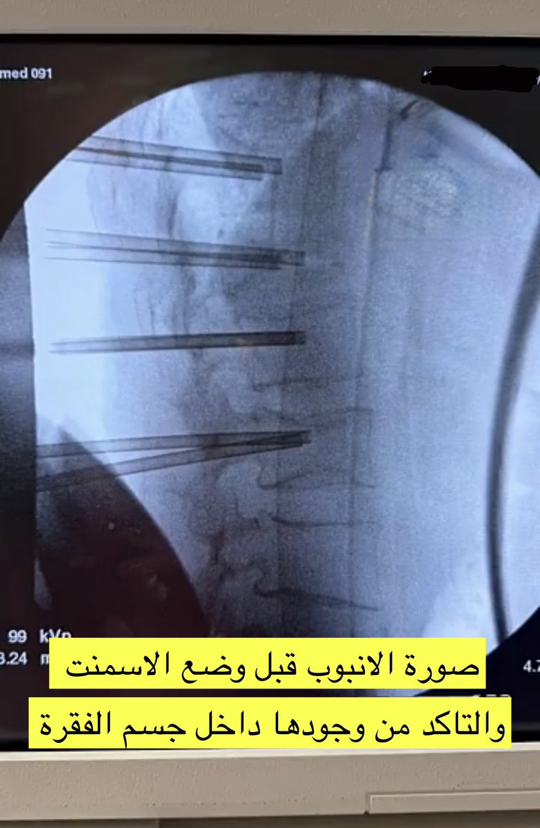 drwaleedq's tweet photo. ✨ حالة جديدة لمريضة بعمر 70 سنة
كانت تعاني من آلام شديدة بسبب كسور هشّة في فقرات الظهر…
وبفضل الله ثم التدخل الدقيق، تم حقن إسمنت طبي (Vertebroplasty) لأربع فقرات متجاورة، ودعم الجسم الفقري ومنع انضغاطه وتحسن الألم مباشرة بعد الإجراء.

📌 الإجراء تم تحت الأشعة بدقة عالية، والتأكد من وضع الإبر داخل كل فقرة قبل حقن الأسمنت.
وخرجت المريضة وهي بحالة ممتازة ولله الحمد.

الطب الدقيق يصنع فرقاً… والحالات الصعبة تُعالج إذا وُجد القرار الصحيح والوقت المناسب.
#جراحة_العمود_الفقري
#تقوية_الفقرات
#هشاشة_العظام #كسور_الفقرات