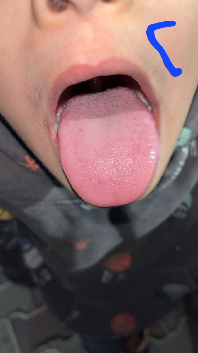 شوفوا لسان طفل مريضي قبل تناول الكمثرى والخيار و بعد تناول الكمثرى والخيار

الصورة الأولى قبل فترة اللسان هنا يدل على أن الطفل قد يصاب لا سمح بداء السكري بسبب ان لديه حرارة داخلية عالية في الجسم ونقص الين

الصورة الثانية بعد تناول الخيار والكمثرى يوميا وبعد اكثر من ٣ اشهر .. هنا