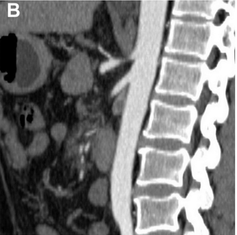 JVS - Venous and Lymphatic Disorders tweet media