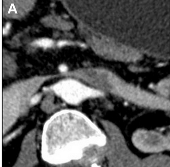 JVS - Venous and Lymphatic Disorders tweet media