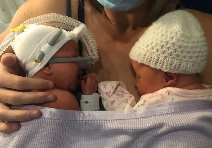 LifeNewsHQ's tweet image. Doctors Told Mom to Abort a Disabled Twin, She Refused and Both Babies are Doing Great buff.ly/8u4dCBd