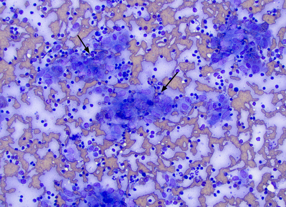 eClinPathCU's tweet photo. Aspirate of splenic nodules in a 5 year old cat. There were aggregates of macrophages (arrows, image 1) with intercalated neutrophils (arrow, image 2). Non-staining bacterial rods are in the macrophages (image 3), indicating a mycobacterial infection. https://t.co/MO7ngMvNHc