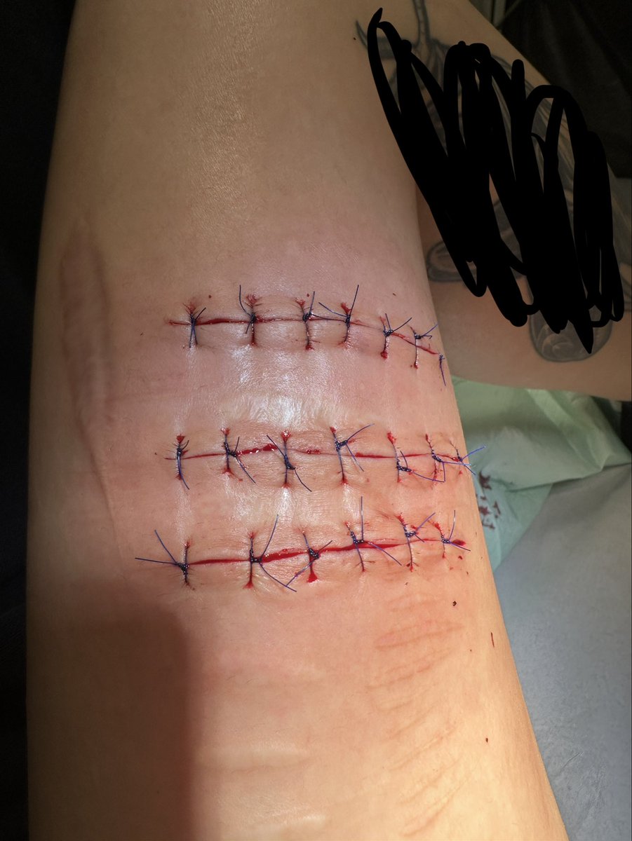 20 stitches (before photo on my profile)