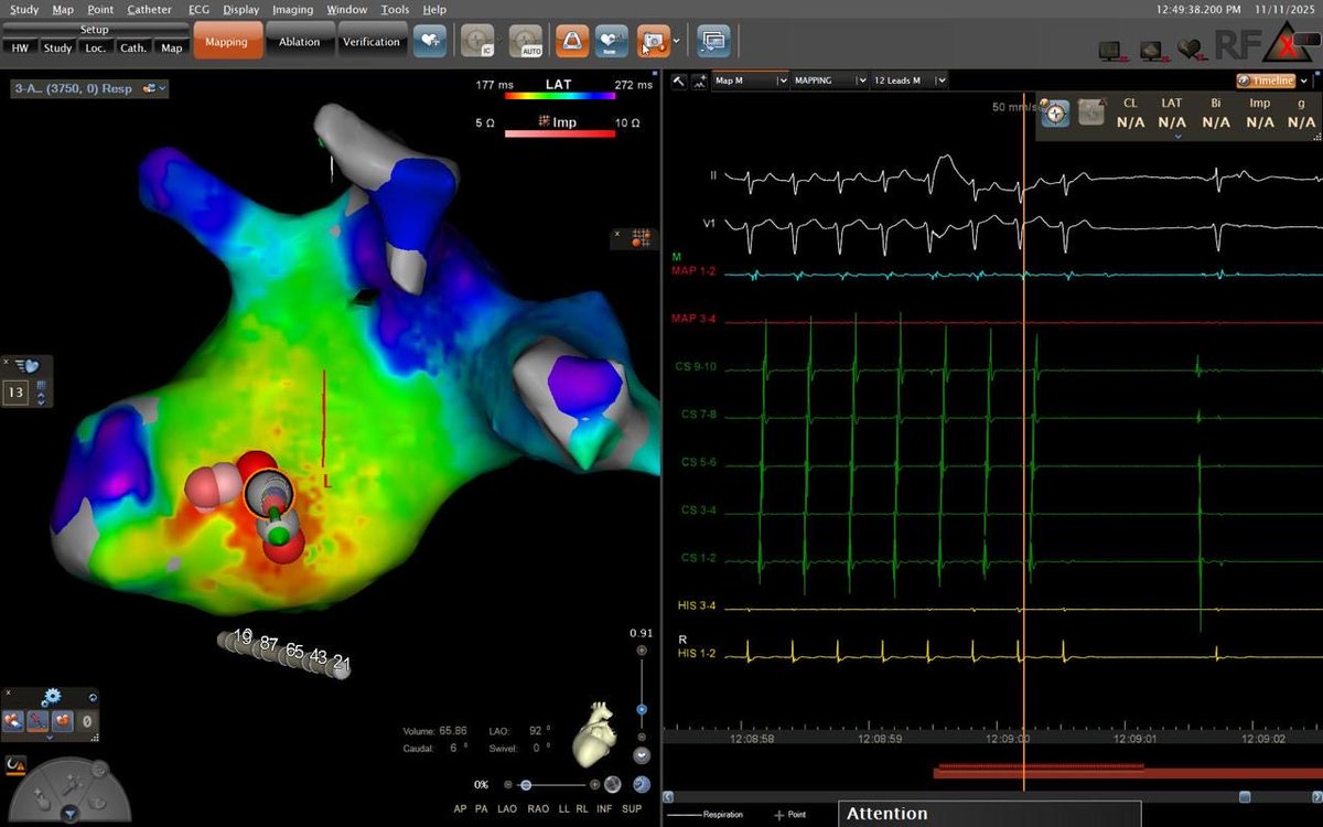 El <a href="/ISSSTE_mx/">ISSSTE</a> realizó por primera vez un estudio electrofisiológico de mapeo electroanatómico en 3D que permite diagnosticar y corregir arritmias cardíacas. Esto se llevó a cabo en Querétaro, donde el señor Carlos Felipe ahora está libre de arritmias. Buscaremos replicar esta