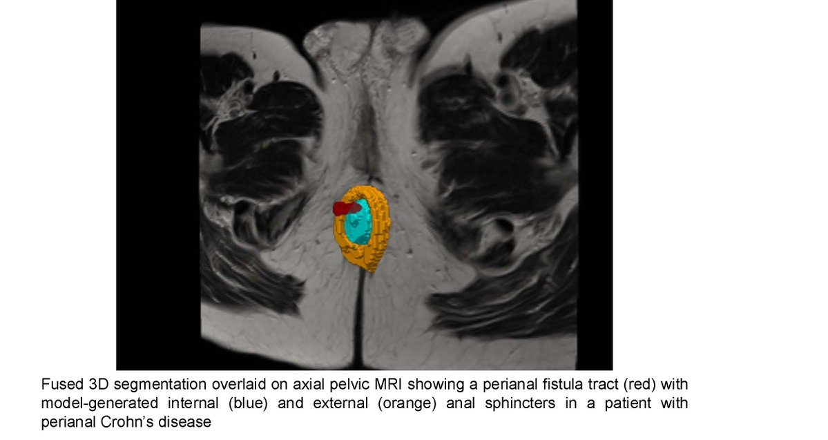 P_DeepakIBDMD's tweet image. Delighted to share that the @HelmsleyTrust has awarded a $3.2 million grant to the three of us: myself @WashUMedGastro @WashUDeptMed, Satish Viswanath, PhD @satishev, an associate professor in the Departments of Pediatrics &amp;amp; Biomedical Engineering @EmoryPediatrics @CoulterBME &amp;amp;…