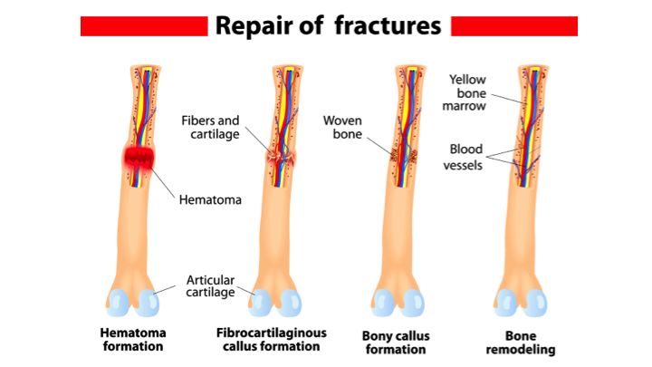surgerygenesis's tweet photo. New fracture-repair research explores stem-cell regeneration, 3D-printed implants, bioactive scaffolds, advanced imaging, and minimally invasive robotic techniques to enhance healing speed, precision, and long-term bone strength.

#FractureRepair #OrthopedicInnovation #newsubmit https://t.co/VKiOPXtUgl