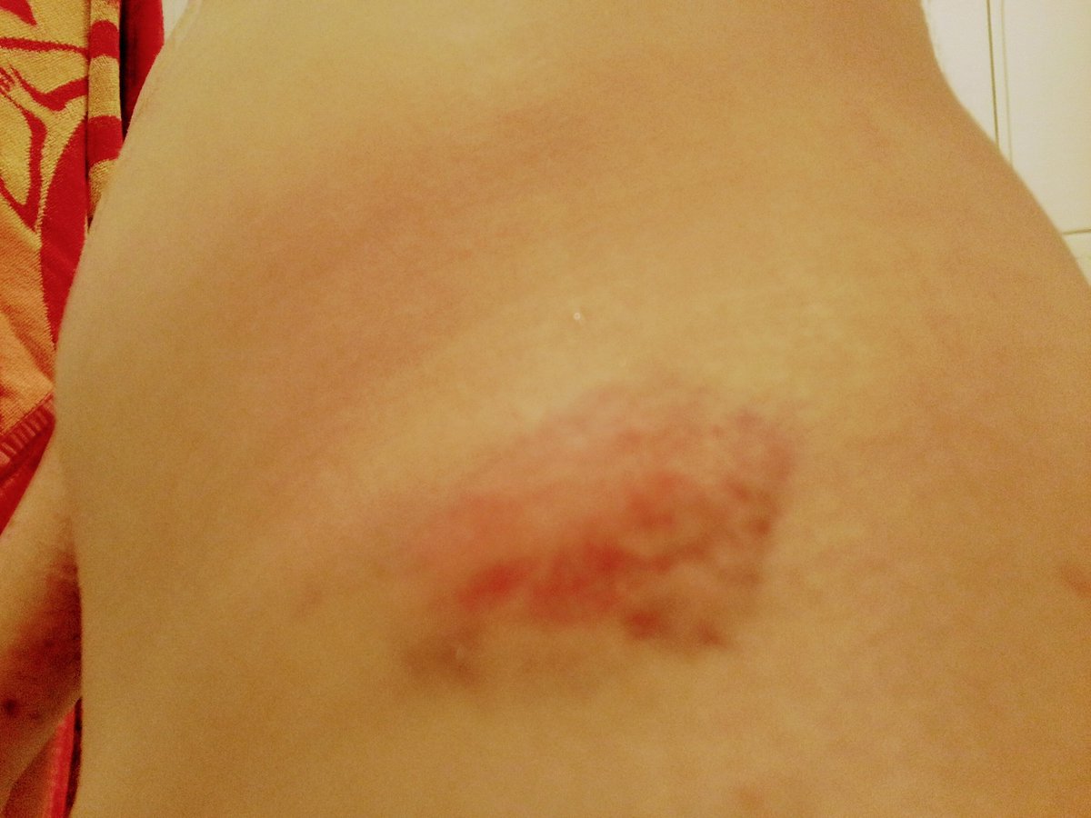 soberragee's tweet photo. Bruises #drugtwt when I'm high I fall everywhere https://t.co/yNfqqB9EJT