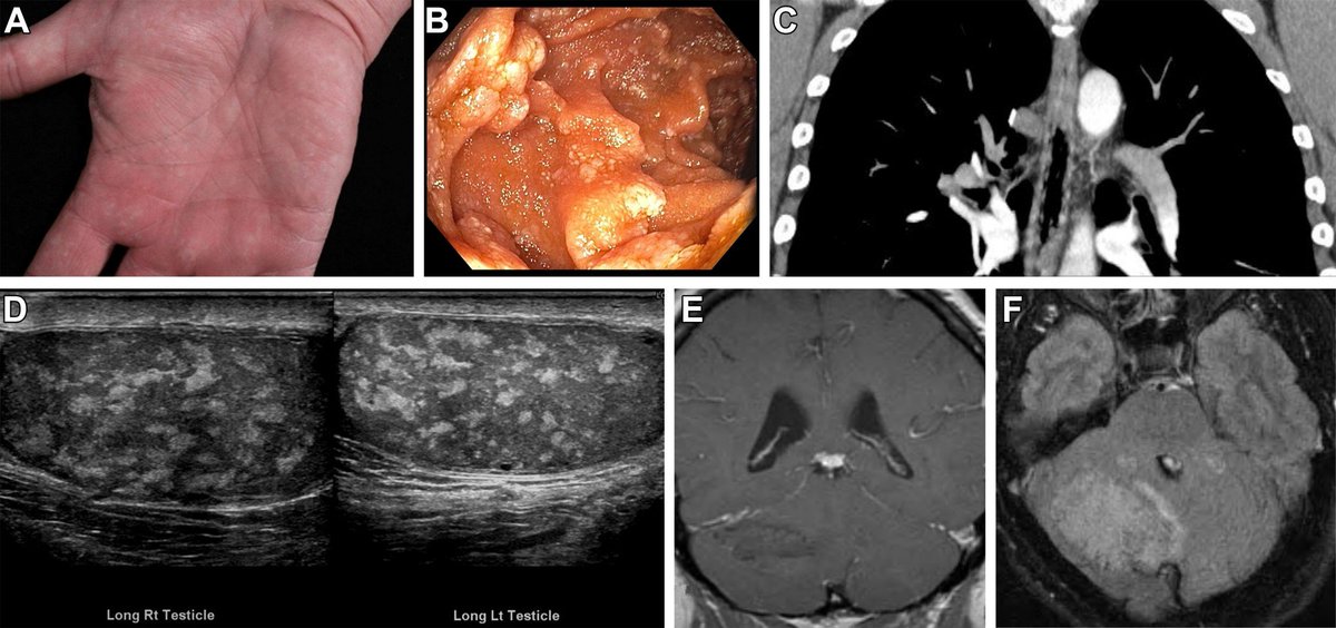 Alarmeddd's tweet image. Can you guess the syndrome?

#MedTwitter #neetpg2025 #INICET