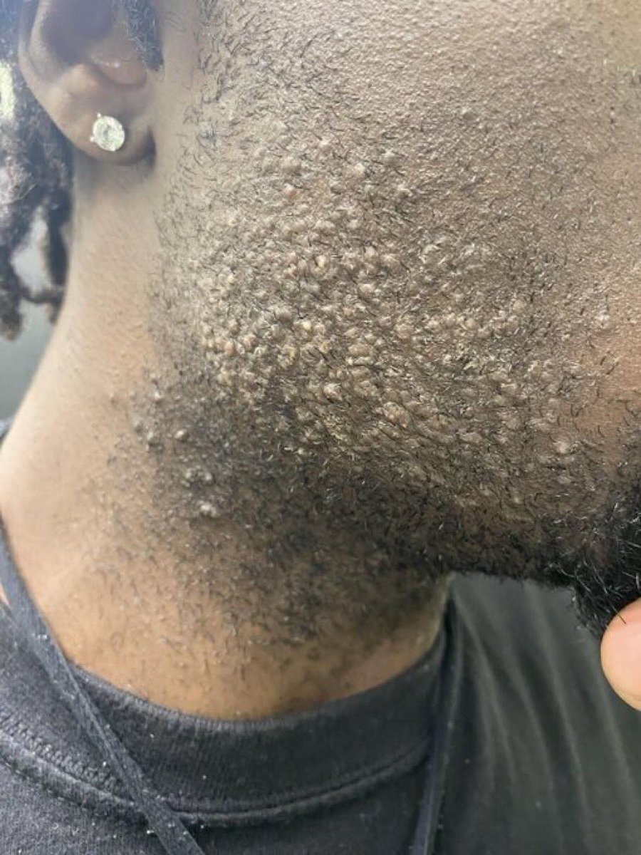 chapps_h's tweet image. Doctors on X,what’s the cause and cure for this?