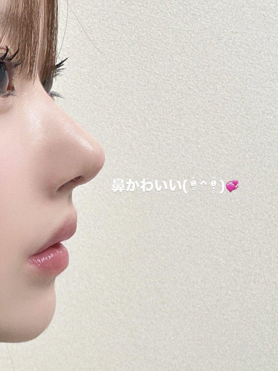 __486B's tweet image. 鼻整形術後7日目💘
抜糸後初めてメイクしたけど鼻が顔に似合ってて可愛くて感動した◟( ᵒ̴̶̷̥́ ·̫ ᵒ̴̶̷̣̥̀ )✨
執刀医はMARQ美容外科のイジェジュン先生です！1年かけてたくさんカウセ回ってここに決めたけど大正解💯♥️