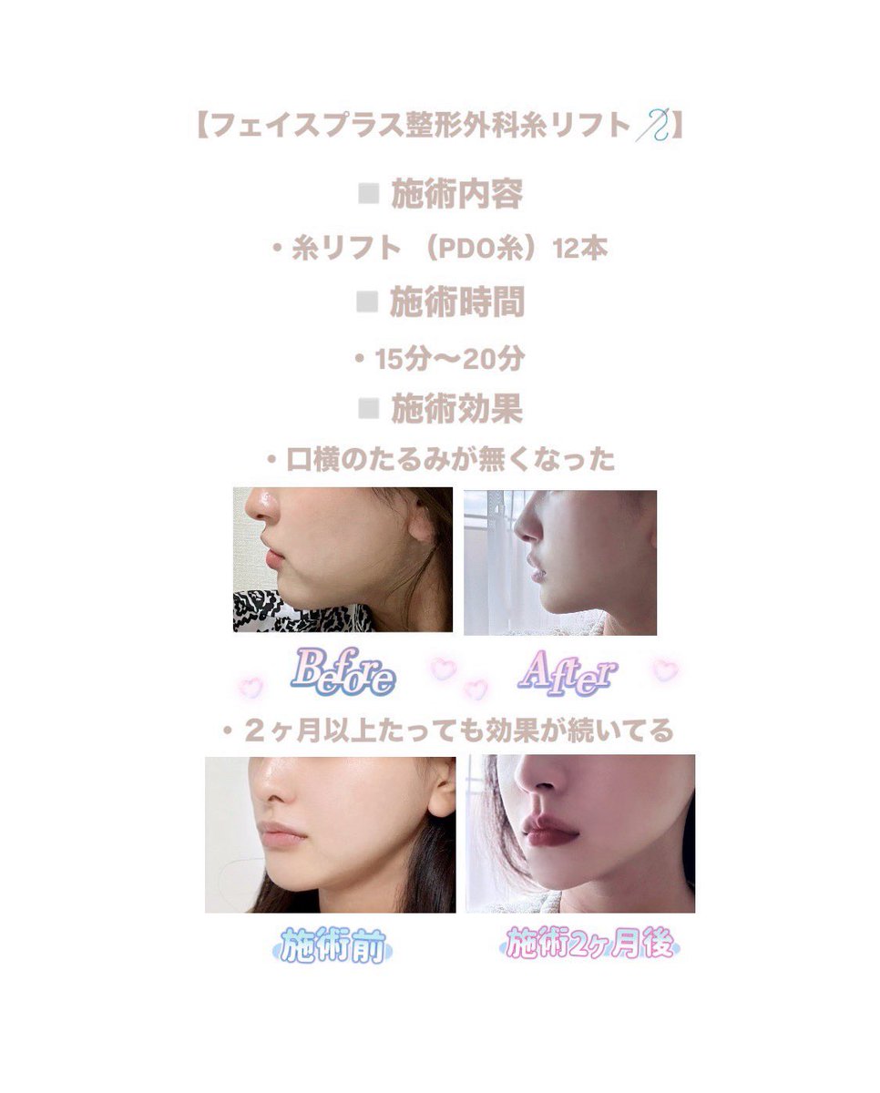 kxe8v0's tweet photo. 気づいたら施術から2ヶ月経ってたんだけど、
あの日の感動そのまま継続中‼️なの強すぎる🪡 https://t.co/mfx7YmlDF0