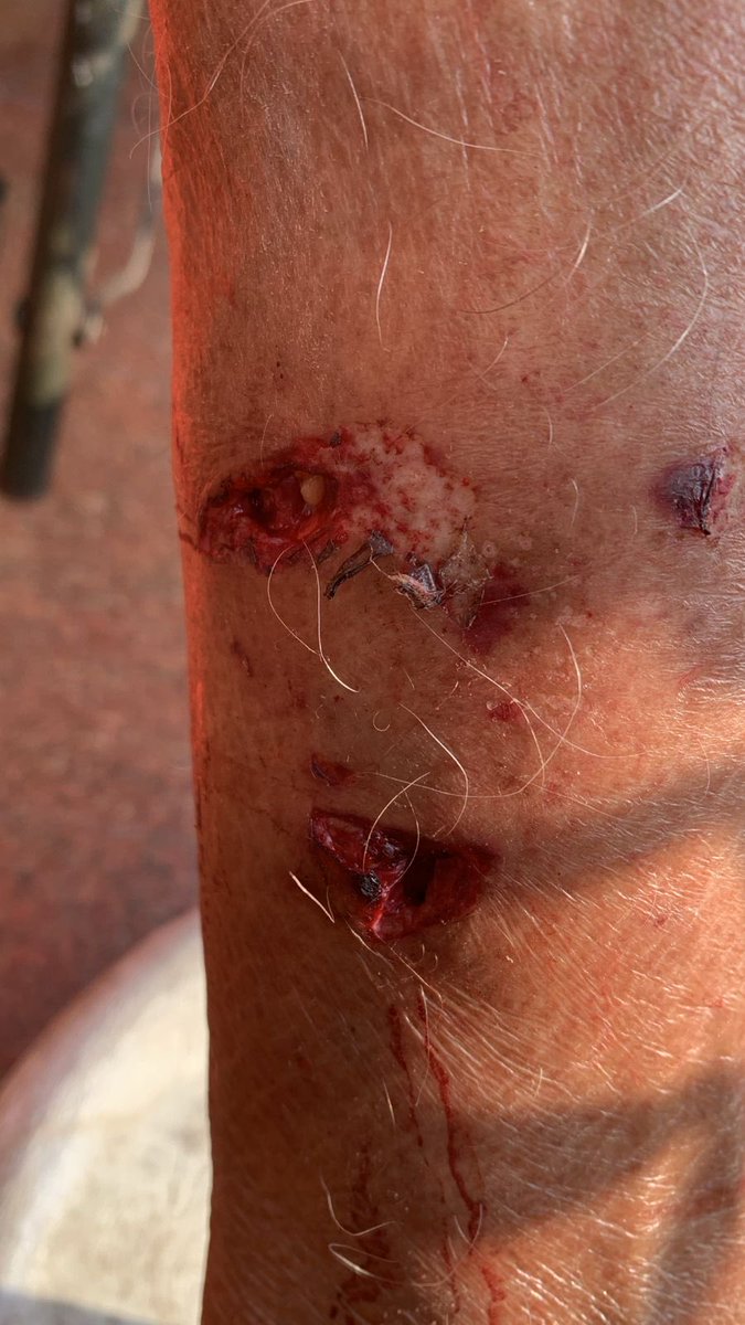 anshularoraaa's tweet photo. @gupta_rekha @MCD_Delhi This is Outrageous. My 90-year-old grandfather was bitten in our own colony, in Outram Lines, Northwest Delhi. The city has already seen over 26,000 dog-bite cases this year. Sterilisation, vaccination and proper on-ground teams can’t keep getting delayed. https://t.co/ndlQrCZtVT