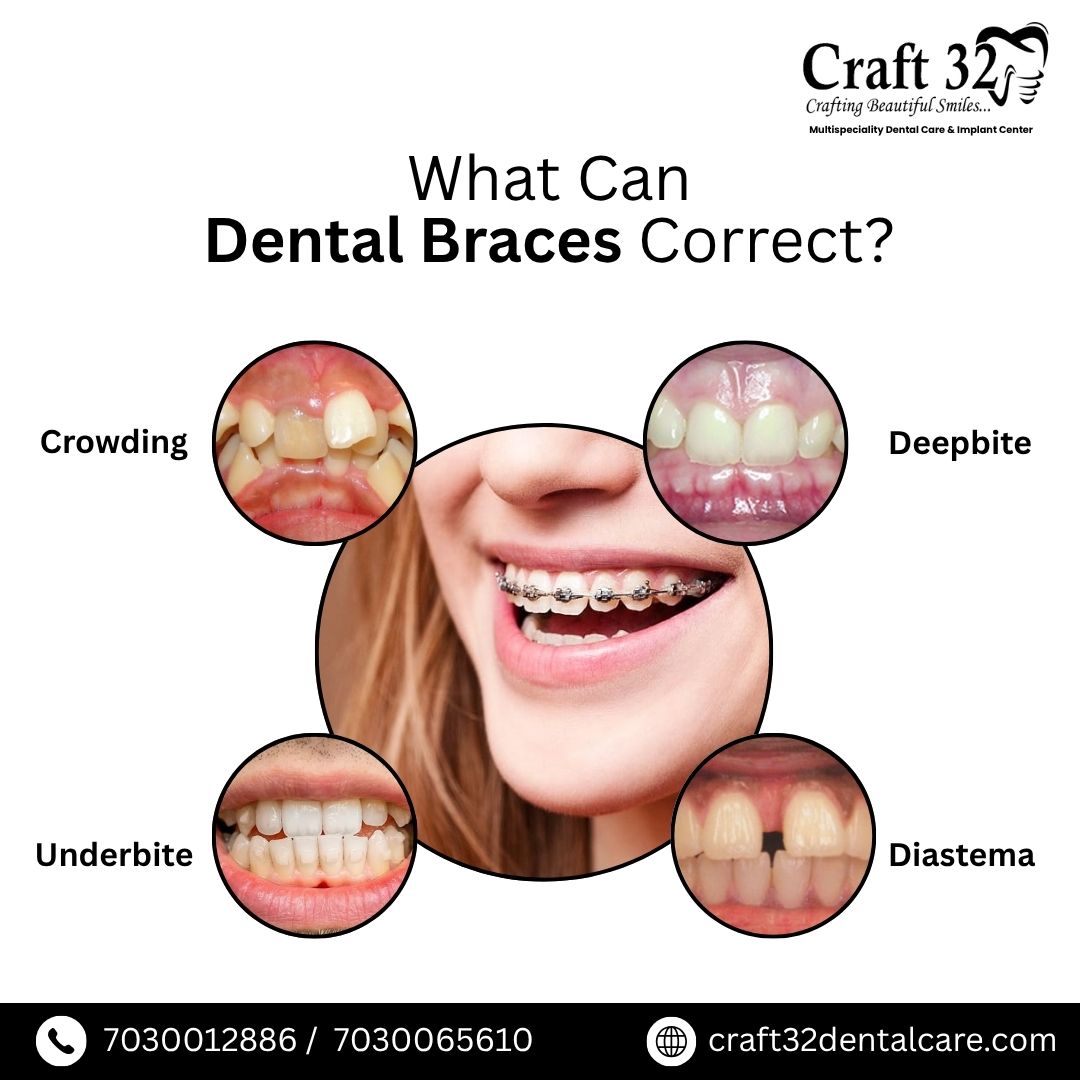 32_craft86706's tweet image. Braces Treatment (Without Extraction)
🦷 Straighter teeth, no extractions needed! Get the smile you deserve with expert orthodontic.
#crowning #braces #deepbite #Craft32DentalCare #PuneDentist #BanerMahalungeDentalClinic