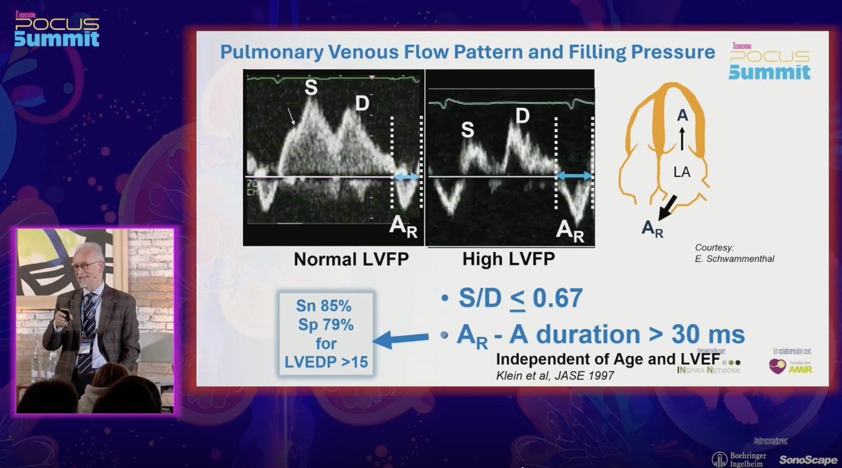 🔍 Detecting Volume Intolerance Through Filling Pressures
Brilliant presentation by Prof. <a href="/AleksandarNesk6/">Aleksandar Neskovic</a>  at the #PoCUSummit highlighting the value of pulmonary venous Doppler. Patterns such as S/D ≤ 0.67 and prolonged AR–A duration reliably reflect elevated LV filling