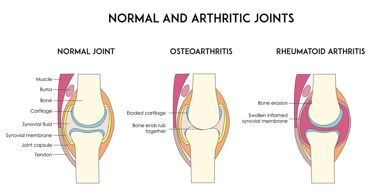 McVitamins's tweet image. What exactly is arthritis?   Things you can do to manage it naturally.
buff.ly/wrqtqu0 
Questions?  Ask me